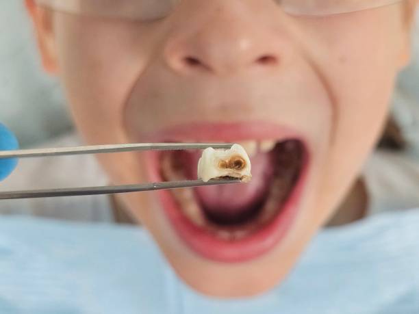 Best Dental Abscess Treatment in Rockmart, GA
